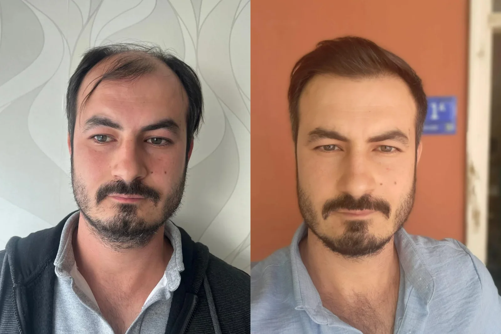 before and after of our patients